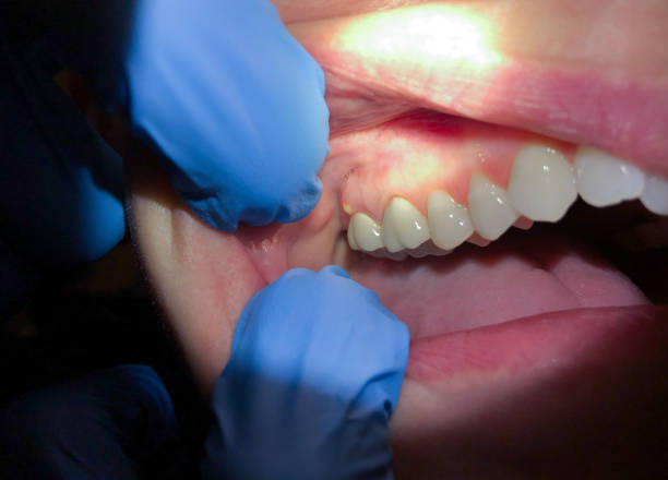 Best Emergency Treatment for Oral Infections in Nashotah, WI